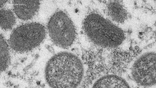 New presumed case of monkeypox reported in central Virginia