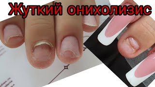 вырван ноготь с мясом ужасный маникюр онихолизис как с ним бороться наращивание ногтей на онихолизис