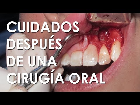recomendaciones despues de una cirugia de cordales