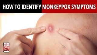 MonkeyPox: This Is How MonkeyPox Symptoms Occur In 4 Stages | NewsMo