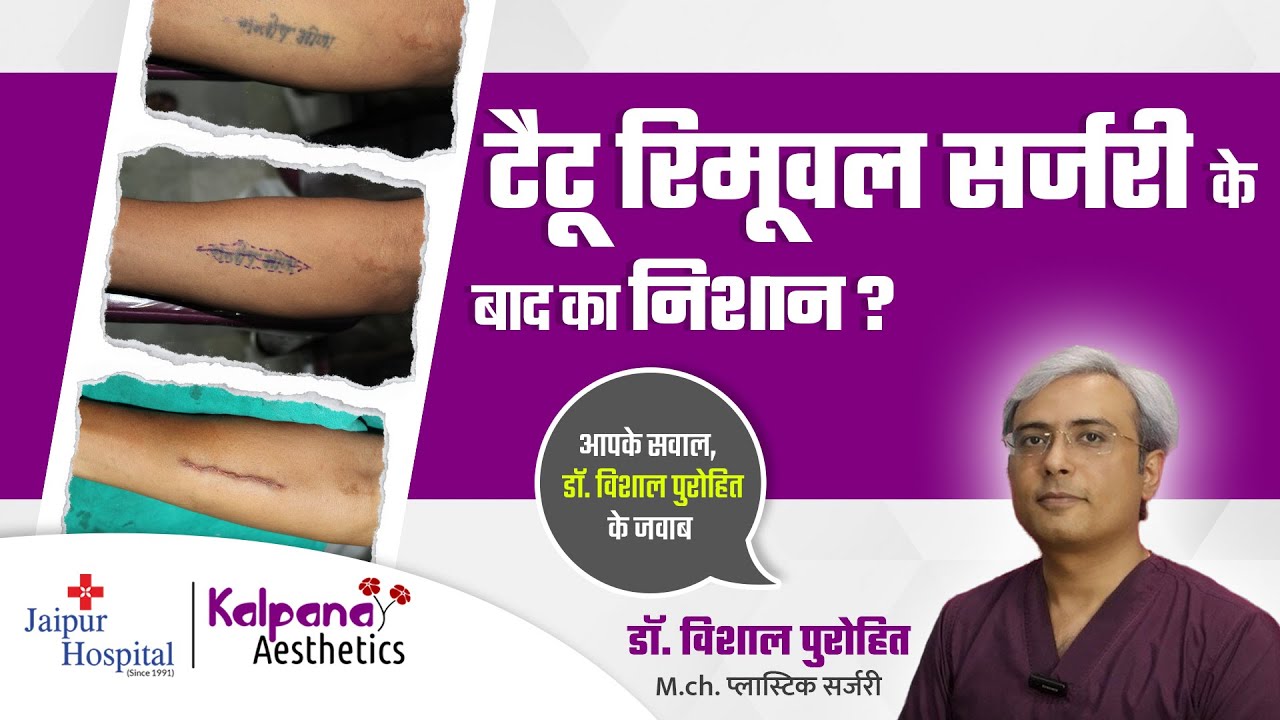 Scar After Tattoo Removal Surgery | टैटू रिमूवल सर्जरी के बाद का निशान ? | Kalpana Aesthetics
