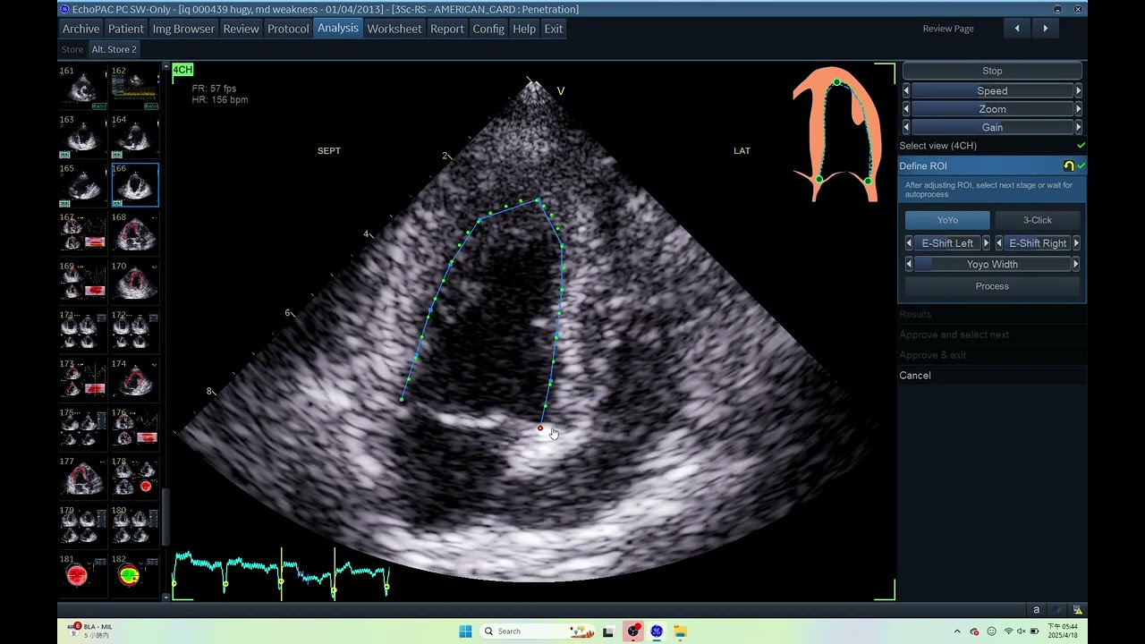 IQ 439  AUTOEF ECHOCARDIOGRAPHY ECHO PAC ANALYSIS HWD FCEMS