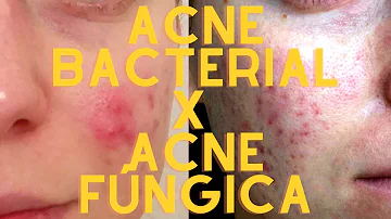 Como tratar acne fúngica?