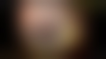 EUS-guided drainage of walled-off necrosis with lumen apposing metal stent (Hot Spaxus)