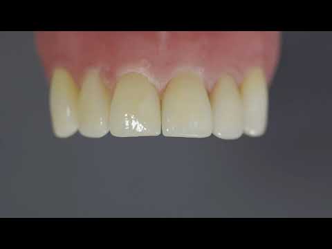前歯部Ⅲ級窩洞への充填修復（撮影協力：田代浩史先生）| 使用ステップの概要 | クリアフィル ® マジェスティ ® ESフロー Low Universal