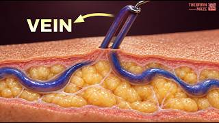 How Varicose Veins Are Treated