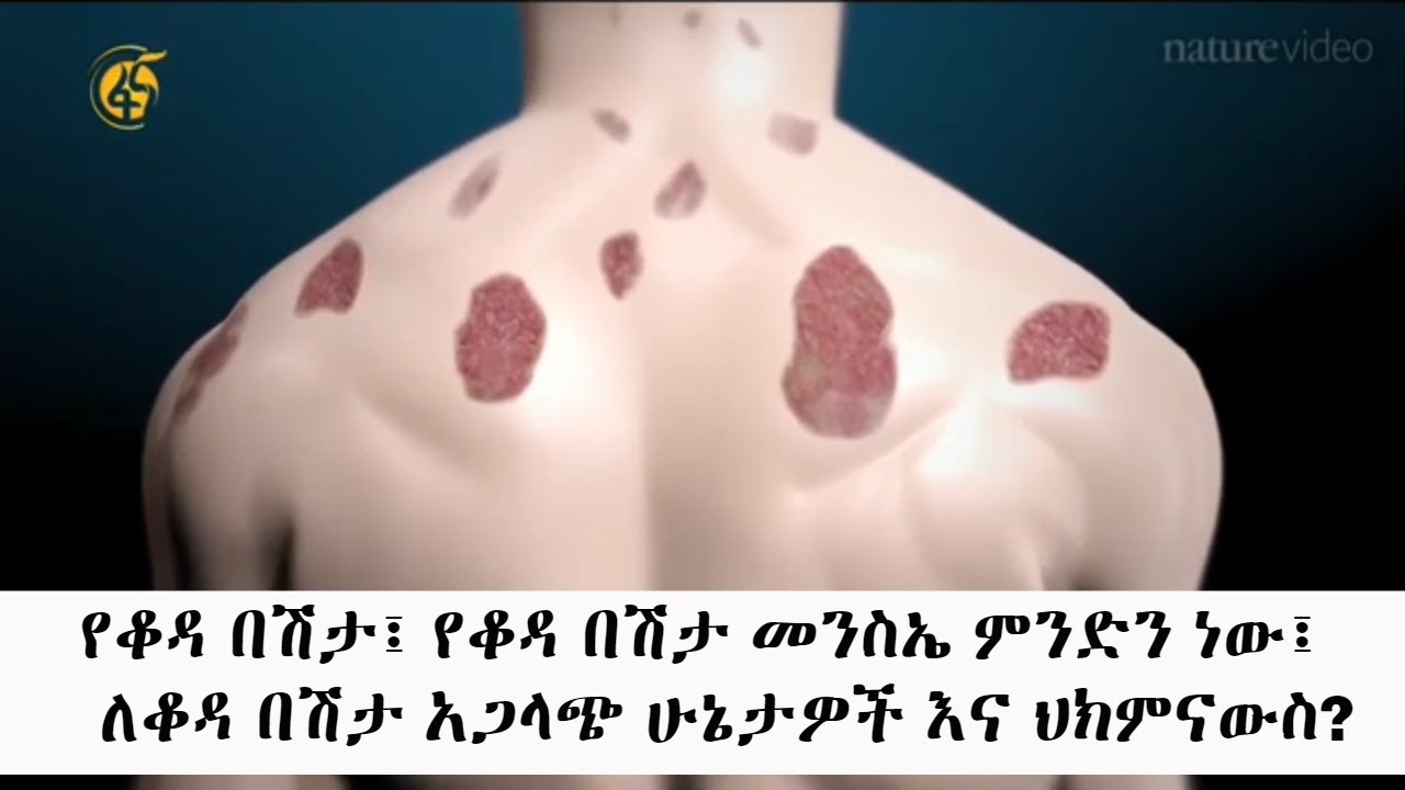 የቆዳ በሽታ፤ የቆዳ በሽታ መንስኤ ምንድን ነው፤ ለቆዳ በሽታ አጋላጭ ሁኔታዎች እና ህክምናውስ? #ጤናችን