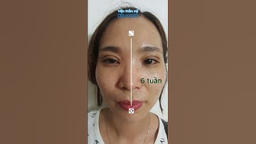 Mở rộng góc mắt và cắt mí mắt đẹp tự nhiên không sẹo - TS.BS Phạm Cao Kiêm #shorts