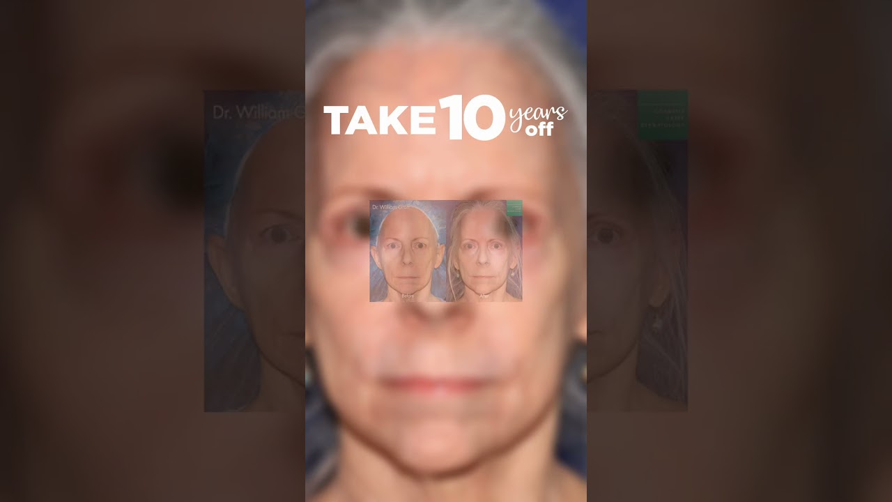Banner for How can you take 10 years off your face? #Take10 #LaserResurfacing