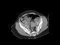 Occlusion intestinale - 2. Occlusion grêlique