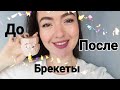 Брекеты До После. 3,5 года до мечты✨🤞🏻 Брекеты конец истории)