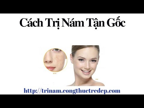 Cách Trị Nám Tận Gốc | Bí Quyết Trị Nám Hiệu Quả Nhất