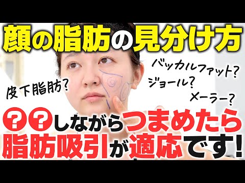 【誰でも簡単】顔の脂肪吸引で重要な「皮下脂肪」と「バッカルファット」の見極め方とは？セルフチェックで皮下脂肪やバッカルファット/ジョールファットなどの顔の脂肪を見分けられます！