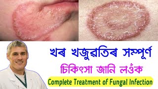 খৰ খজুৱতিৰ সম্পূৰ্ণ চিকিৎসা - Complete Treatment of Fungal Infection | Ringworm Infection | Assamese