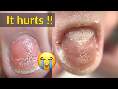 Damaged Toenails | Mississauga Foot Clinic