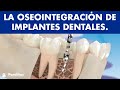 La oseointegración de implantes dentales - ¿En qué consiste? ©