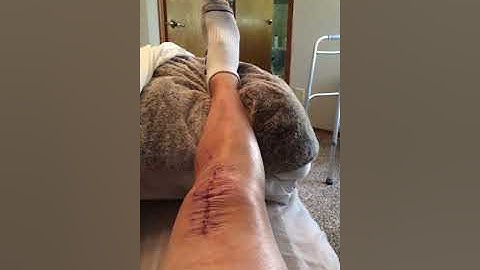 Total Knee Replacement Day 3: Understand what