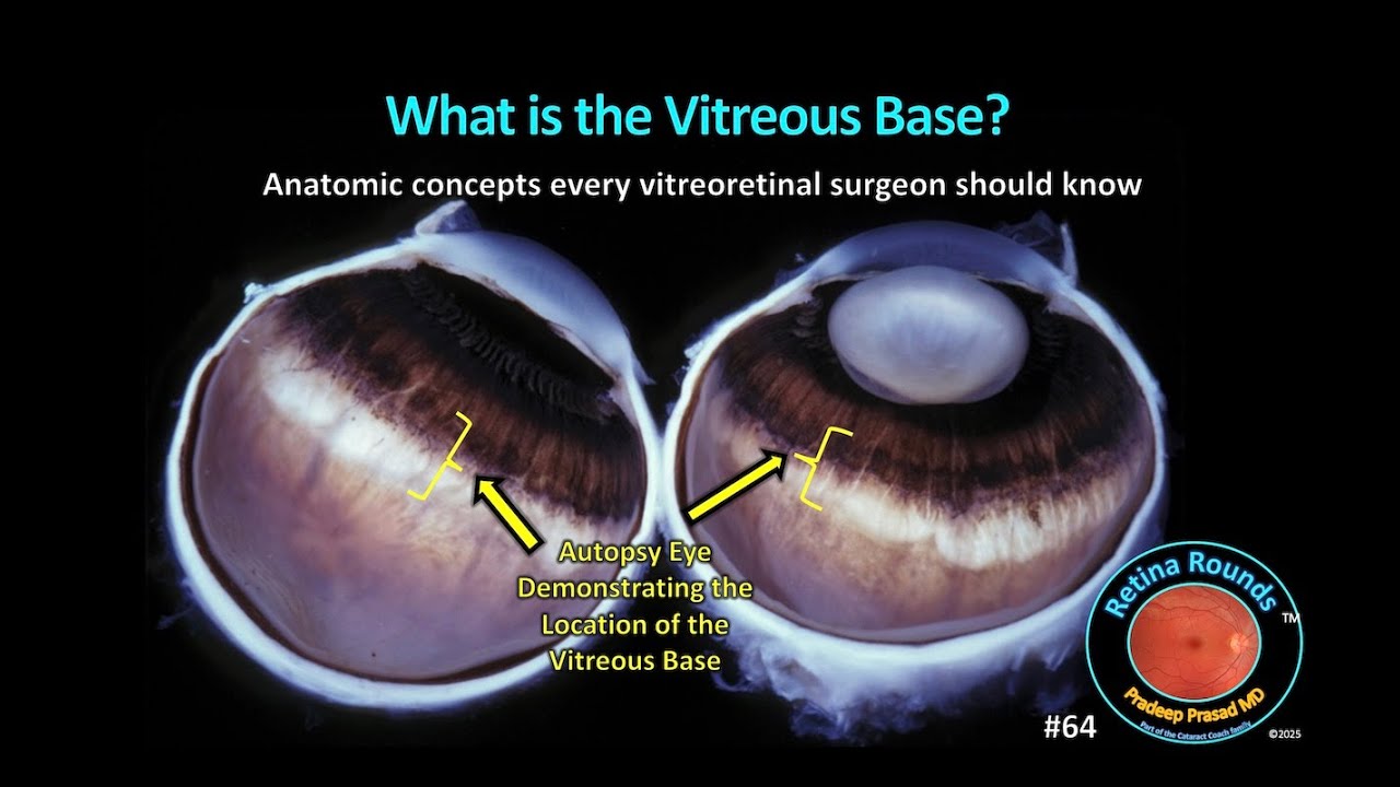 RetinaRounds™ 64: What is the Vitreous Base?