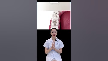 Phuơng pháp phục hình răng sứ Inlay onlay #nhakhoaachau #dentist