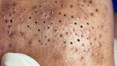 ACNE TREATMENT - #209