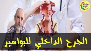 وصفات لعلاج النزيف الداخلي للبواسير  -  الدكتور كريم العابد العلوي  _