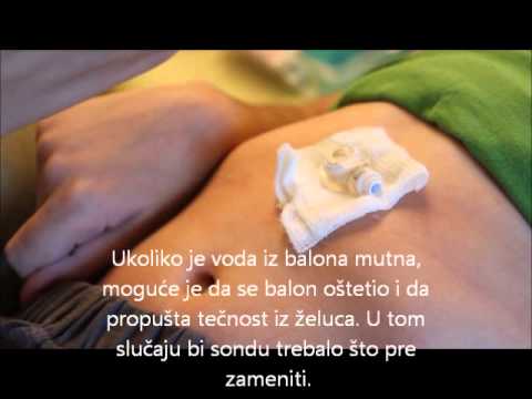 Video: Umetanje Cijevi Za Hranjenje (gastrostomi)