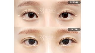 [B&amp;A] 비절개눈매교정+윗트임+뒤트임+밑트임 3개월차