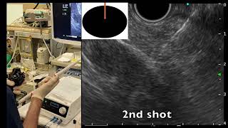 EUS-RFA of a pancreatic NET.