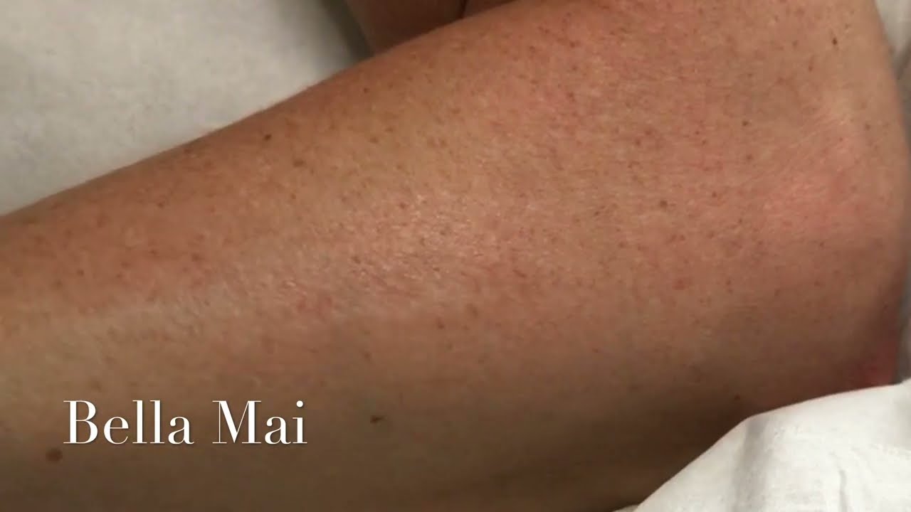 Scar Treatment by MicroArt Semi Permanent Makeup Camouflages Scars