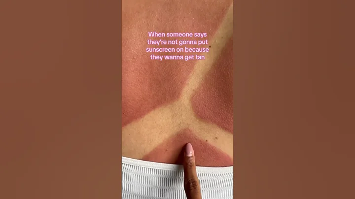 POV: ME REMEMBERING TO PUT ON SUNSCREEN☀️#cocoandeve #sunscreen #spf #sunburn #tanning #summer