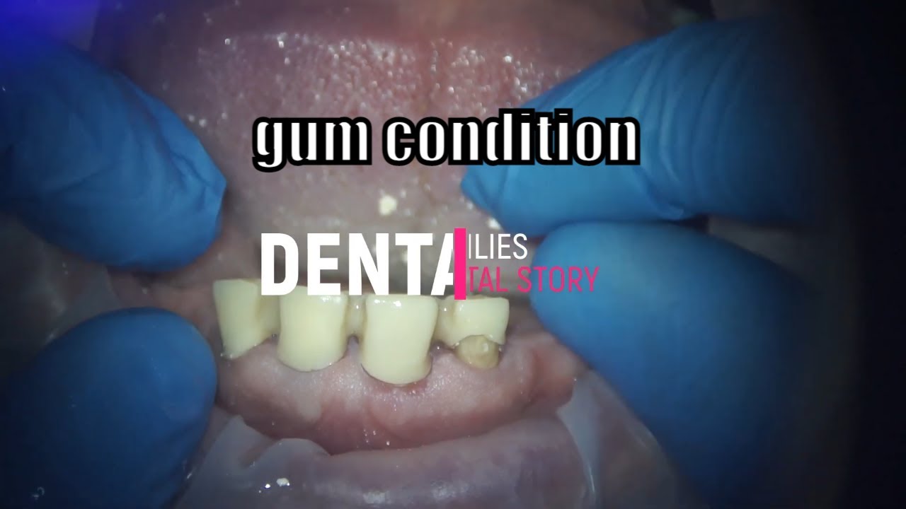 gum condition after temporary plastic crowns on the teeth dentist teeth dental dentistry 