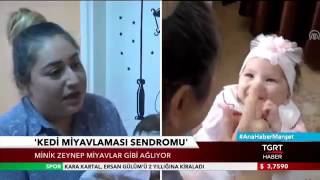 Kedi Miyavlaması Sendromu Hastalığı Olan Zeynep Bebek Resimi