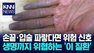 'It's Not Just the Cold': The Life-Threatening 'Blue Lips' / KNN