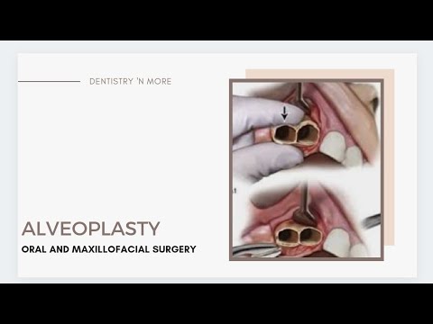 Video: Alveoloplasty isiyoambatana na uchimbaji ni nini?