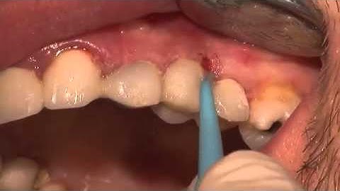 Utilisation du composite Reflectys (Itena ) en cas hostile :  Reconstitution d’une couronne