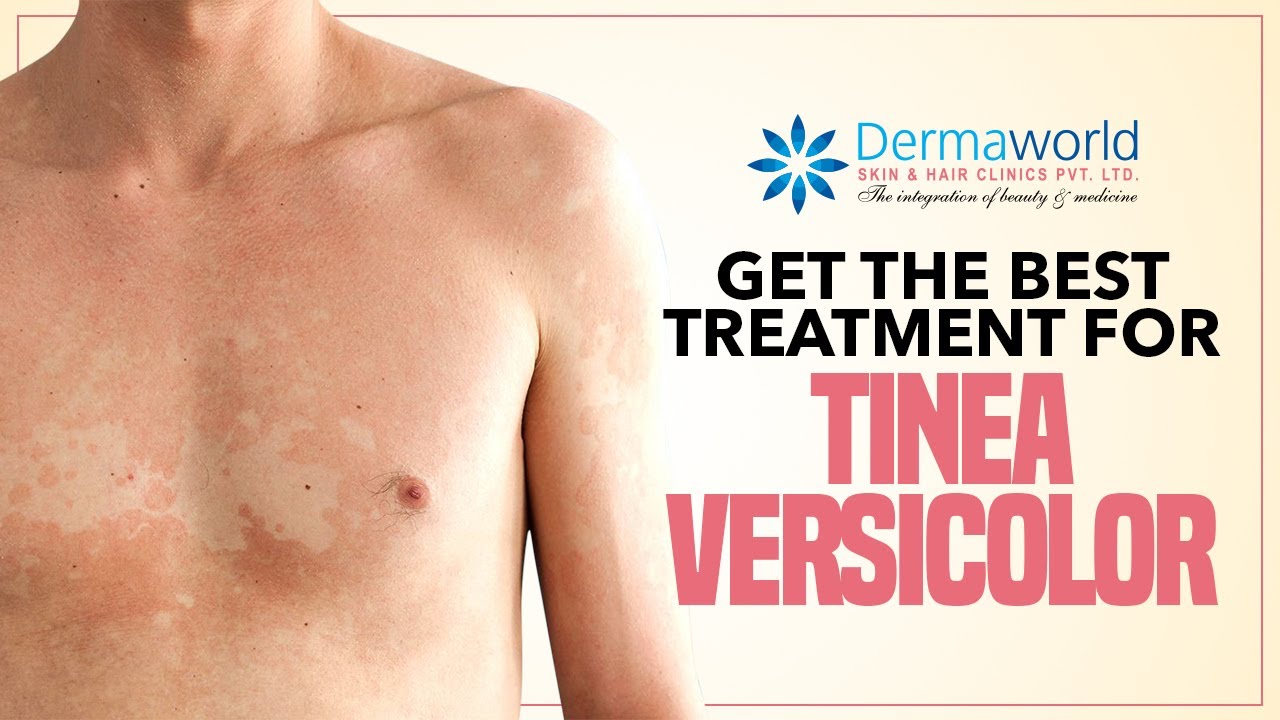 Get The Best Treatment For Tinea Versicolor Youtube