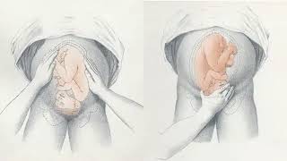 Obstetric Abdominal Examination | Pregnant Abdomen Examination | Four Leopold Maneuvers