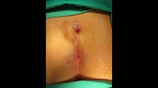 Kıl Dönmesi Ameliyatı Pilonidal Sinus