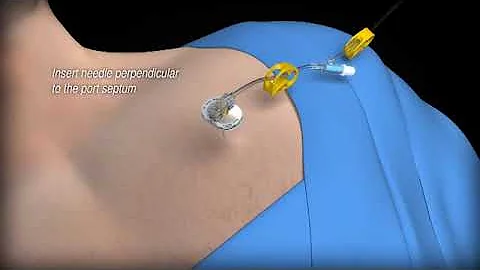 SafeStep™ Port Access Kit Demonstration