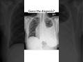 Guess the diagnosis? Wait for the end #chestxray #xray #lungs #radiographer #medicalimaging #india