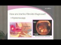 Non-Surgical Treatment for Uterine Fibroids at JFK Medical Center