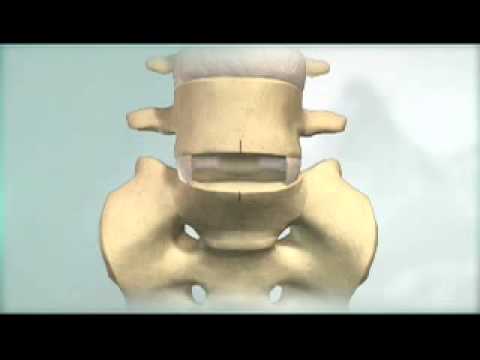 Операция замена дисков позвоночника. Имплантирование позвонка. Имплант межпозвоночного диска. Искусственный межпозвоночный диск. Операция по смене позвоночного диска.