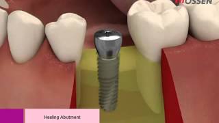 Hiossen-Osstem ETIII Implannt Placement with Taper Kit