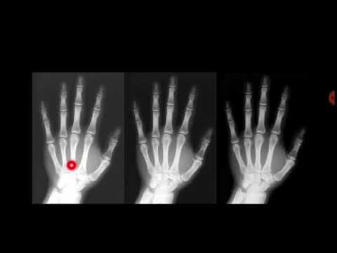 Video: ¿Qué es la f alta de nitidez geométrica en radiografía?