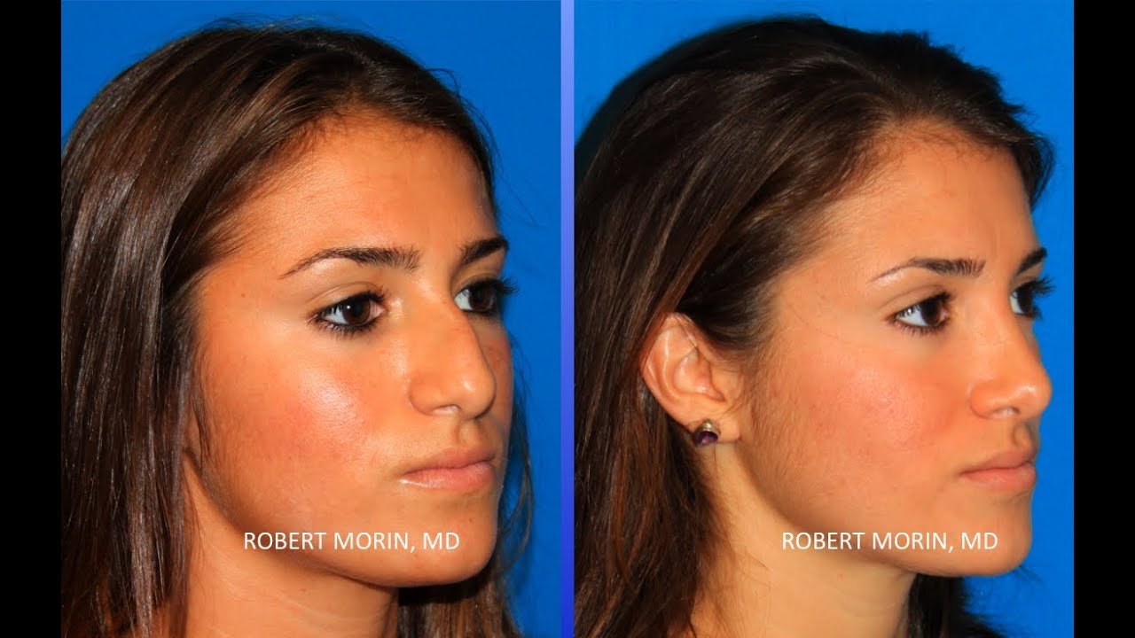 Rhinoplasty NYC Before and After Plastic Surgeon Robert Morin MD YouTube