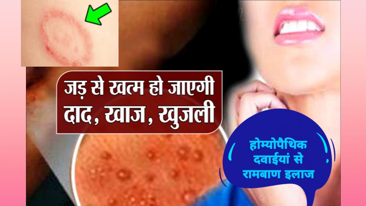 RINGWORM, दाद, खुजली का इलाज होम्योपैथिक दवाईयो के द्वारा। HOMEOPATHIC