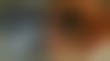 ERCP Stone Extraction #BD_ENDOSCOPY