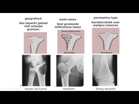 Video: De Pijn Van Osteosarcoom