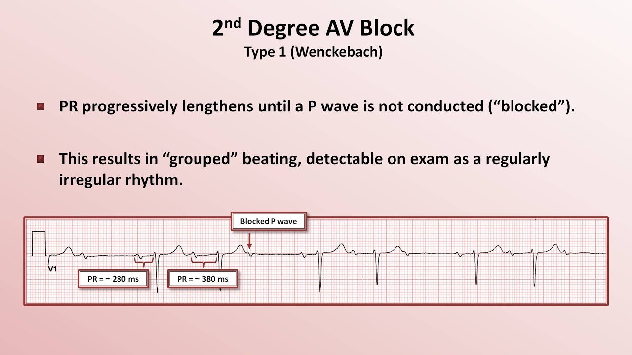 Av block remover сайт. 3rd degree av Block ECG. Av Block III ECG. Av Blocks 3 degree ECG. EKG complete av Block.