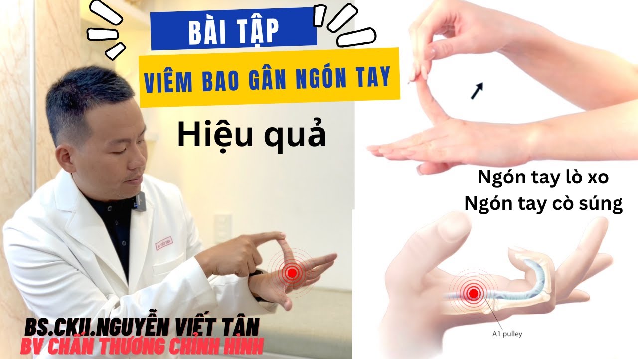 Bài tập trị đau ngón tay viêm bao gân ngón tay - ngón tay lò xo - ngón ...